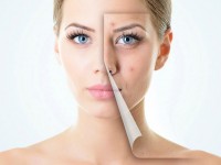 Эффективное лечение акне в клинике косметологии: путь к чистой коже