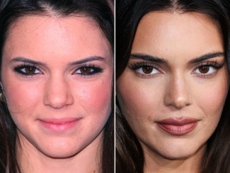 Кендалл Дженнер пластические операции до и после смотреть фото Кендалл Дженнер пластические операции до и после смотреть фото