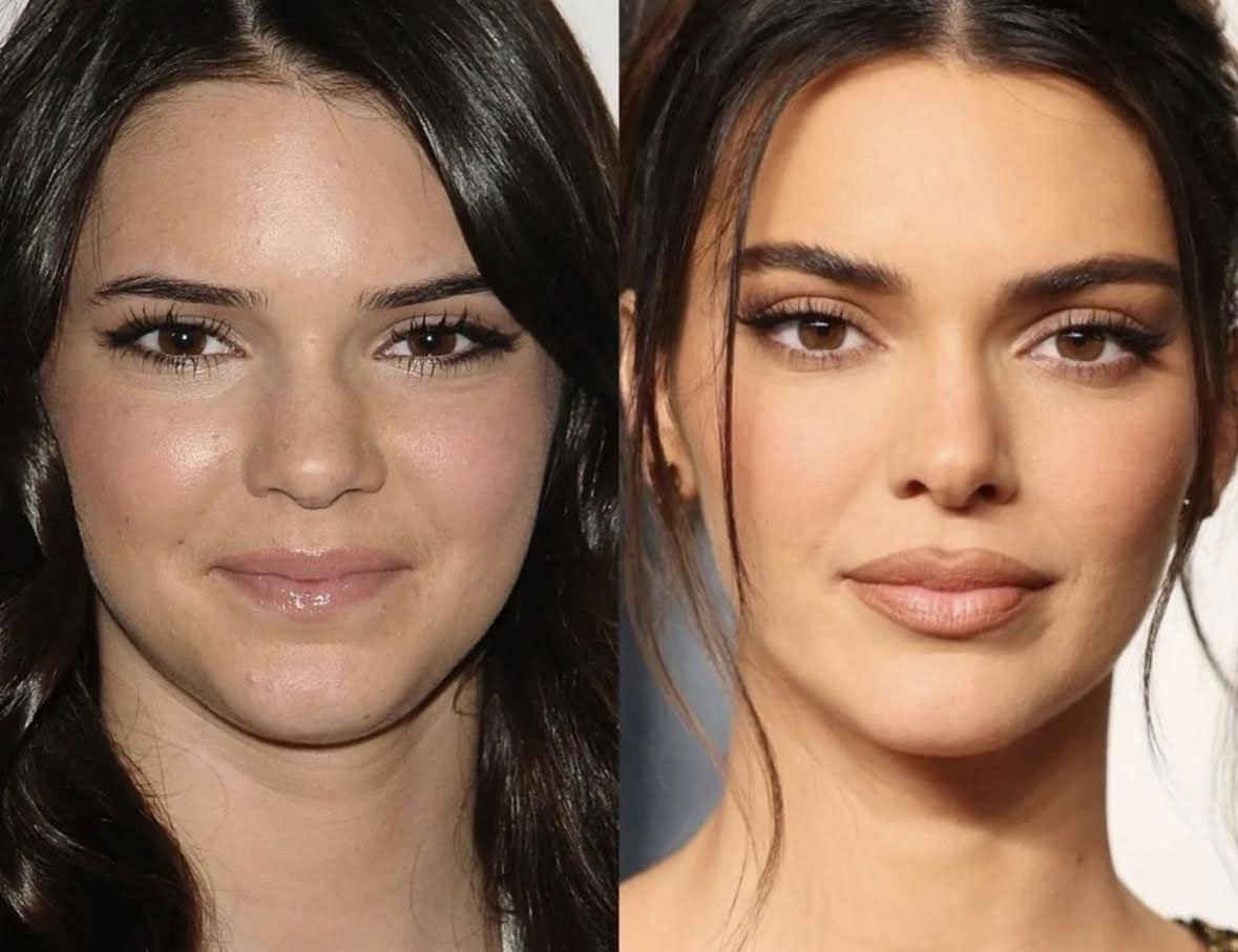 Кендалл Дженнер пластические операции до и после смотреть фото